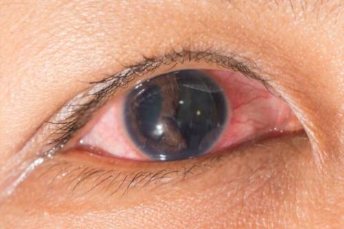Desprendimiento de Retina