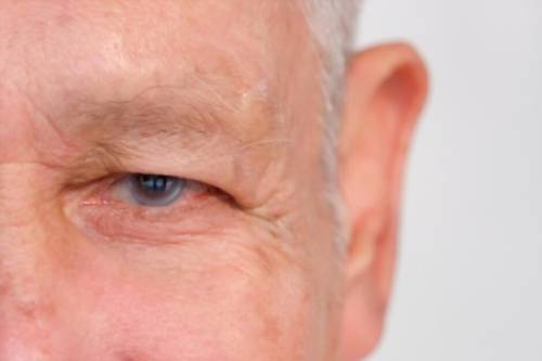 Glaucoma