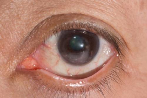 Oclusiones Vasculares de la Retina