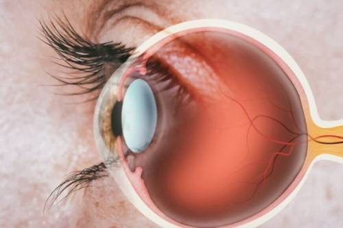 Retinopatía Diabética